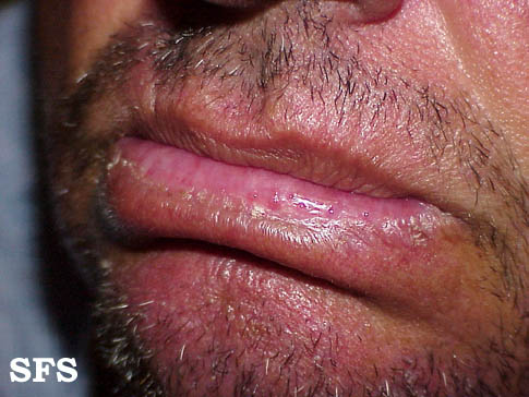 Actinic Cheilitis Pictures