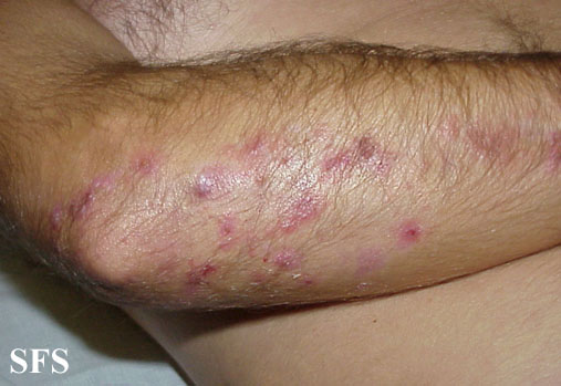 Dermatitis Herpetiformis Symptoms