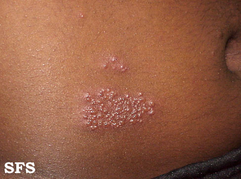 herpes zoster. Images with the same Diagnosis