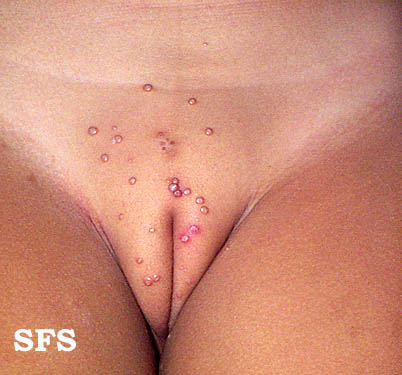 molluscum contagiosum pictures. Images with the same Diagnosis