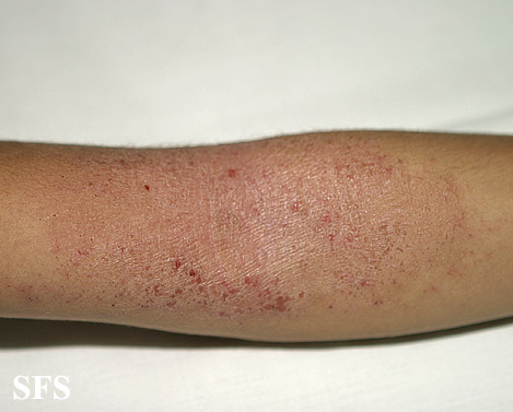 Atopic eczema steroid cream