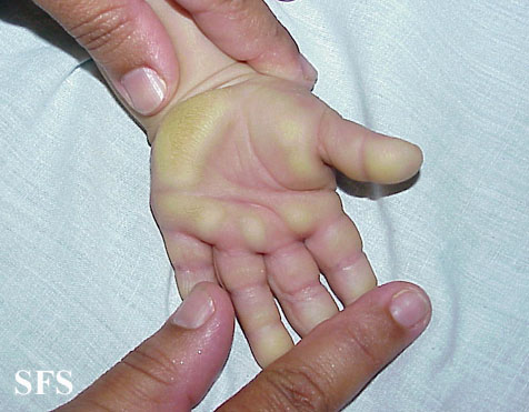 Palmoplantar keratoderma