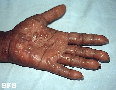 Pomphylox