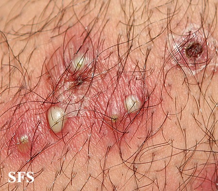 Staph_Skin_Infections-Folliculitis