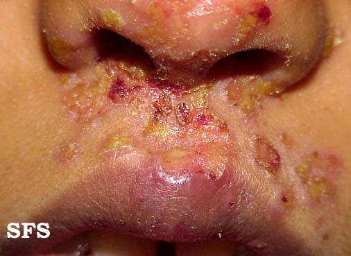 Skin_Staph_Infections-Impetigo