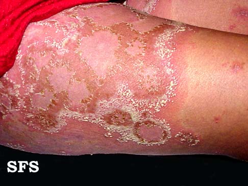 Steroid cream for rash during pregnancy