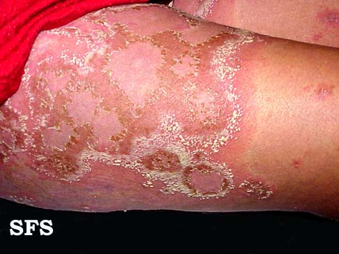 Dermatitis oral steroids