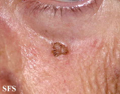 Solar keratosis