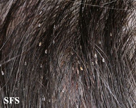 Head lice - pediculosis capitis