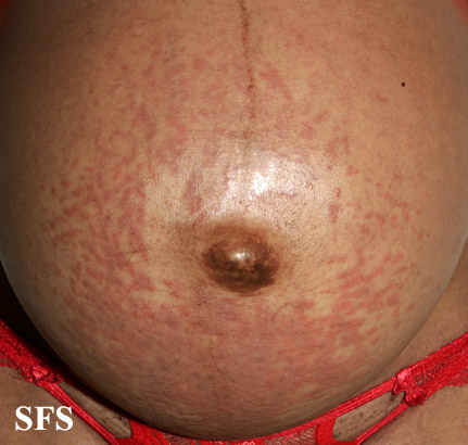 Picture 1: Pruritic Urticarial Papules and Plaques of Pregnancy (PUPPP 