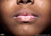 vitiligo