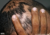 alopecia_areata_and_vitiligo