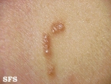 scabies atypical