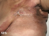 carcinoma erysipeloides