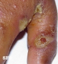 scabies-secondary infection