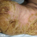 tylotic dermatitis