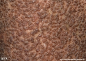 lichen amyloidosus
