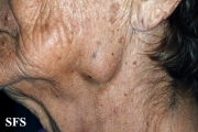 adenocarcinoma-in the submandibular salivary glands