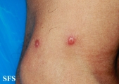 rosai-dorfman disease