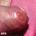 syphilis primary-chancre