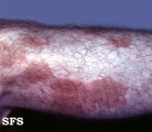 majocchi's disease