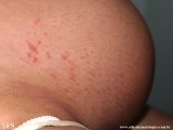 pruritic urticarial papules and plaques of pregnancy