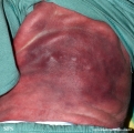 subcutaneous fat necrosis of the newbord