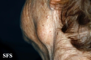 adenocarcinoma-in the submandibular salivary glands