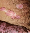 psoriasis_and_vitiligo