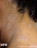 dermatosis cenicienta