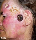 amelanotic lentigo maligna and melanoma