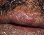 lymphocytic infiltration of the skin