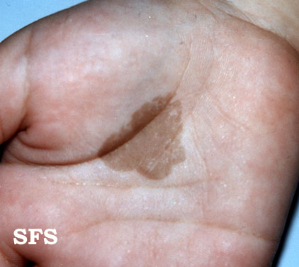 Condition pictured: Tinea Versicolor ⁣⁣⁣ Race: African American ⁣⁣⁣ Notes: Tinea  Versicolor is a fungal infection that causes