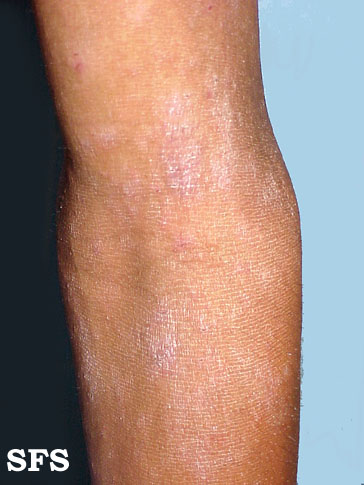 Atopic dermatitis on the inner side of the elbow