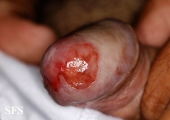 zoon's balanitis