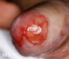 zoon's balanitis