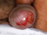 zoon's balanitis