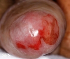 zoon's balanitis