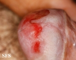 zoon's balanitis