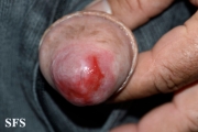 zoon's balanitis