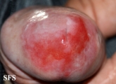 zoon's balanitis