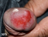 zoon's balanitis