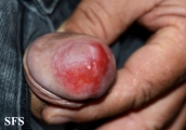 zoon's balanitis