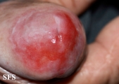 zoon's balanitis
