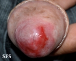 zoon's balanitis