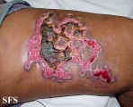 factitial dermatitis