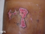 factitial dermatitis