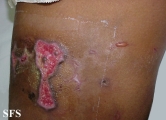 factitial dermatitis