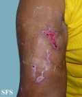 factitial dermatitis