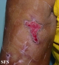 factitial dermatitis